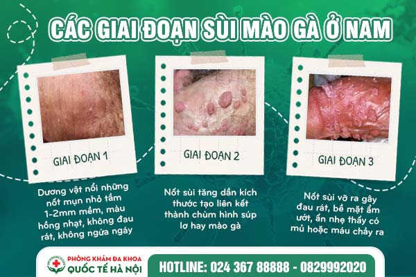 sùi mào gà ở nam